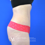 Tummy Tuck Before & After Patient #2689