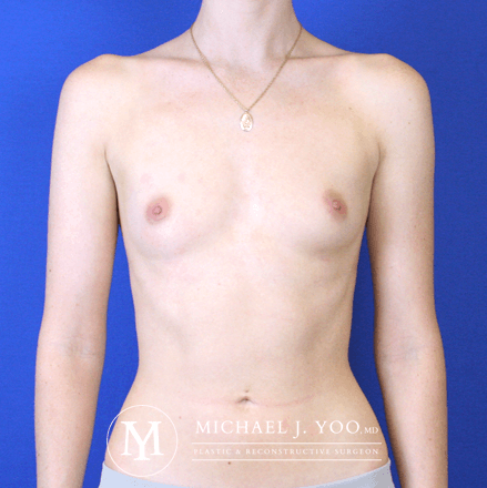 Breast Augmentation Before & After Patient #2764