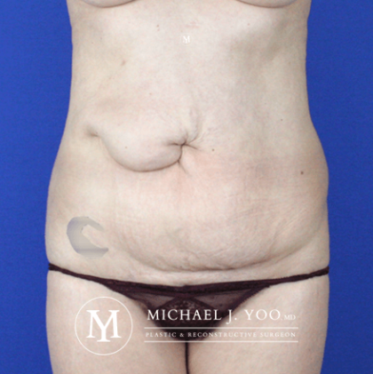 Tummy Tuck Before & After Patient #2689