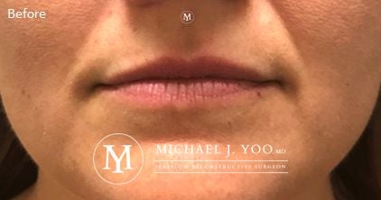 Fillers Before & After Patient #2752