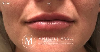 Fillers Before & After Patient #2752