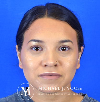 Otoplasty Before & After Patient #2832