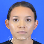 Otoplasty Before & After Patient #2832