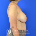 Breast Explant with Lift Before & After Patient #2919