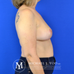 Breast Explant with Lift Before & After Patient #2919