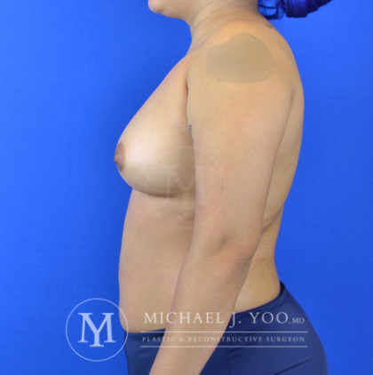 Breast Fat Transfer Before & After Patient #2933