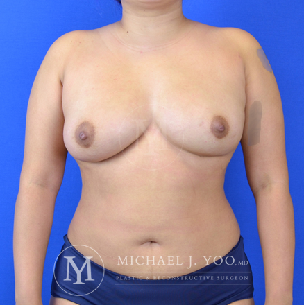 Breast Fat Transfer Before & After Patient #2933