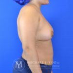 Breast Fat Transfer Before & After Patient #2933