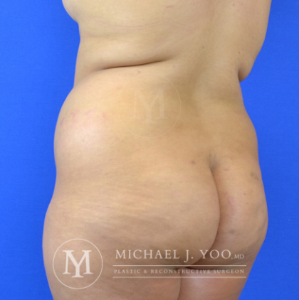 Liposuction Before & After Patient #2944