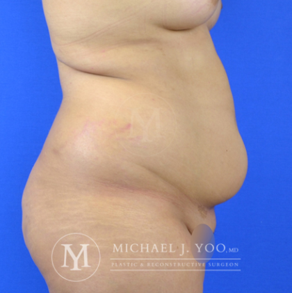 Liposuction Before & After Patient #2944