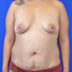 Breast Augmentation Before & After Patient #3016