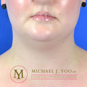 Facial Liposculpture Before & After Patient #3042