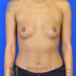 Breast Augmentation Before & After Patient #3050