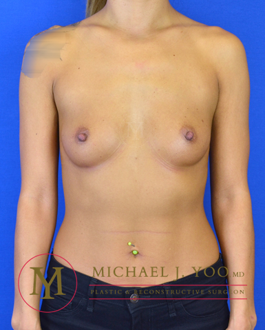 Breast Augmentation Before & After Patient #3050