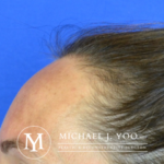 Forehead Reduction Before & After Patient #3057