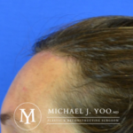 Forehead Reduction Before & After Patient #3057