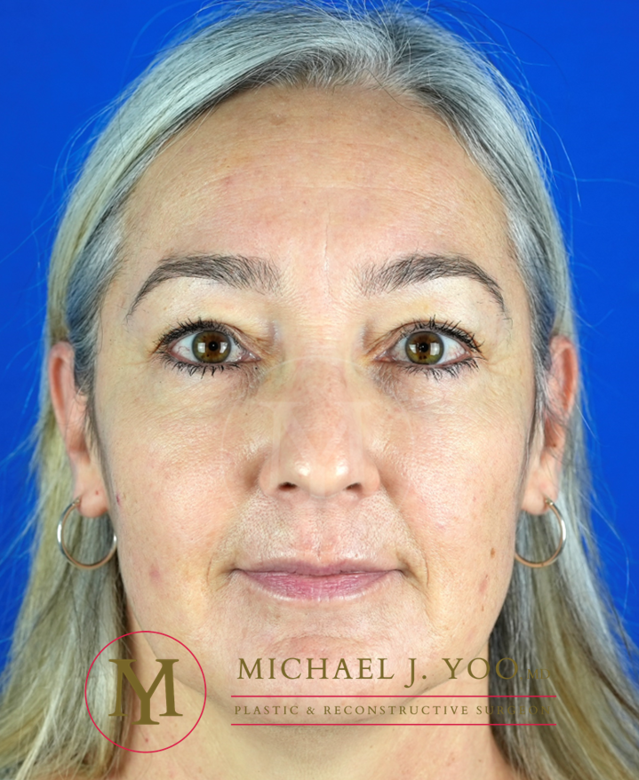 Upper Eyelid Lift Before & After Patient #3087