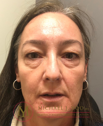 Upper Eyelid Lift Before & After Patient #3087