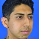 Rhinoplasty Before & After Patient #3091