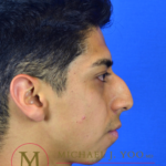 Rhinoplasty Before & After Patient #3091
