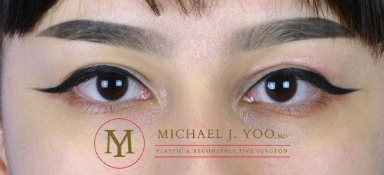 Upper Eyelid Lift Before & After Patient #3115