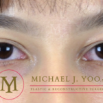 Upper Eyelid Lift Before & After Patient #3115
