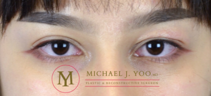 Upper Eyelid Lift Before & After Patient #3115