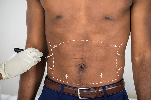 Best African American Tummy Tuck (Abdominoplasty) Orange County