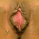 Labiaplasty Before & After Patient #3121