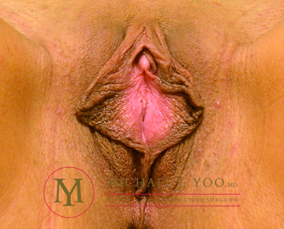 Labiaplasty Before & After Patient #3153