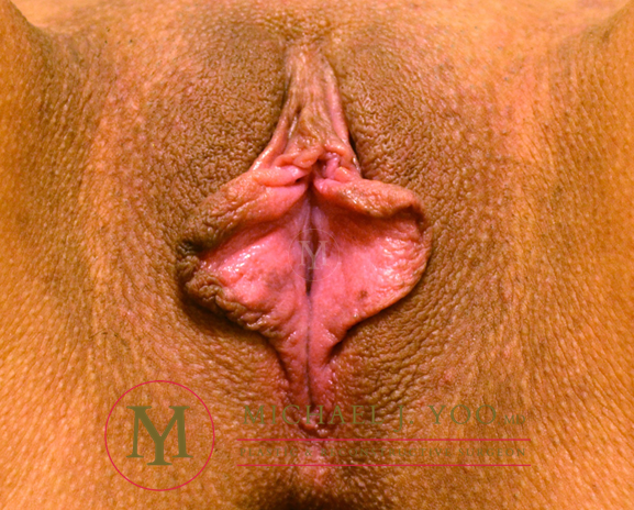Labiaplasty Before & After Patient #3165