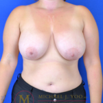 Breast Reduction Before & After Patient #3171