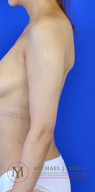 Arm Liposuction Before & After Patient #3178
