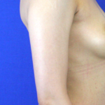 Arm Liposuction Before & After Patient #3178