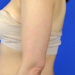 Arm Liposuction Before & After Patient #3183