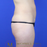 Liposuction Before & After Patient #3224