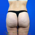 Brazilian Butt Lift Before & After Patient #3217