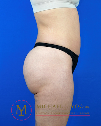 Liposuction Before & After Patient #3224