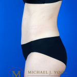 Tummy Tuck Before & After Patient #3238