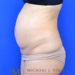 Tummy Tuck Before & After Patient #3238