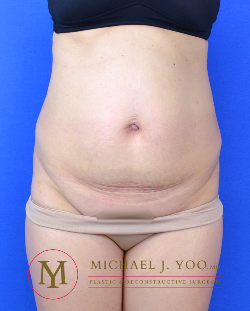 Tummy Tuck Before & After Patient #3238