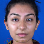 Otoplasty Before & After Patient #3255