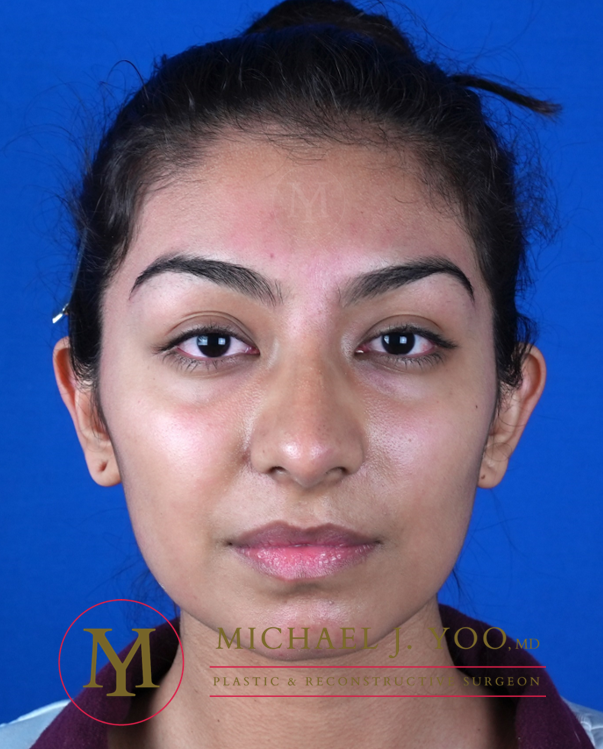 Otoplasty Before & After Patient #3255