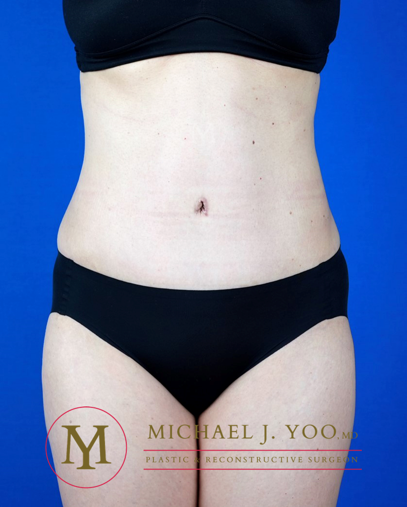 Tummy Tuck Before & After Patient #3238