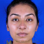 Otoplasty Before & After Patient #3255