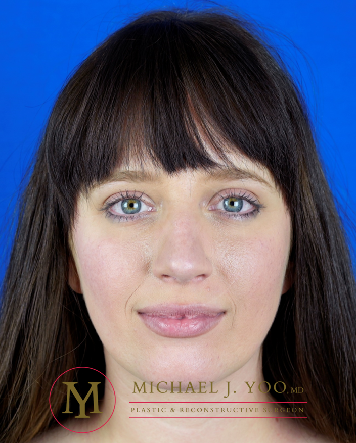 Rhinoplasty Before & After Patient #3295