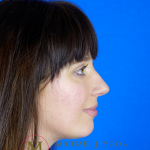 Rhinoplasty Before & After Patient #3295