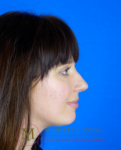 Rhinoplasty Before & After Patient #3295