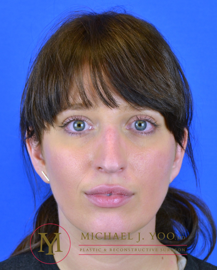 Rhinoplasty Before & After Patient #3295