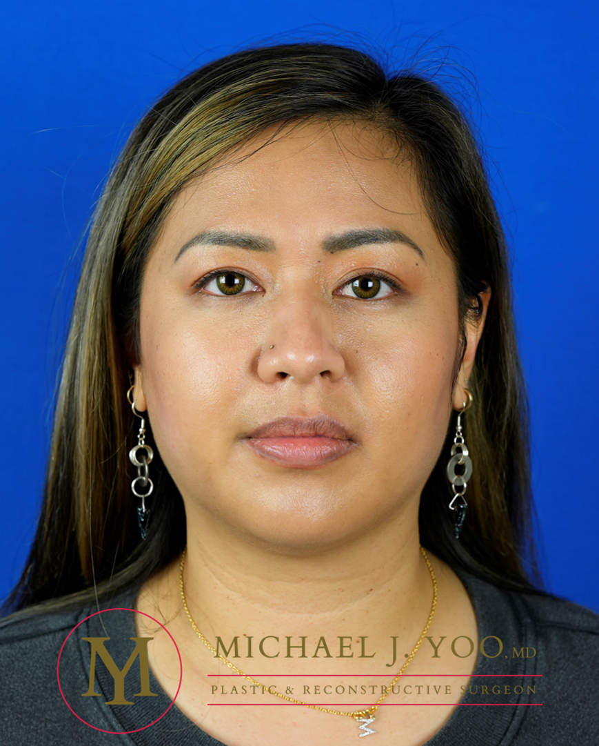 Facial Liposculpture Before & After Patient #3280